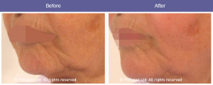 trip facial tightening